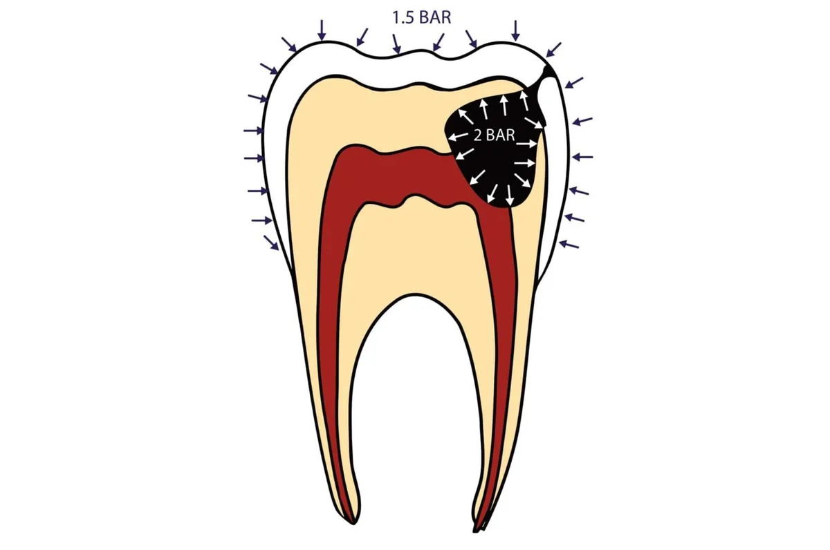 cabin pressure dental pain diagram