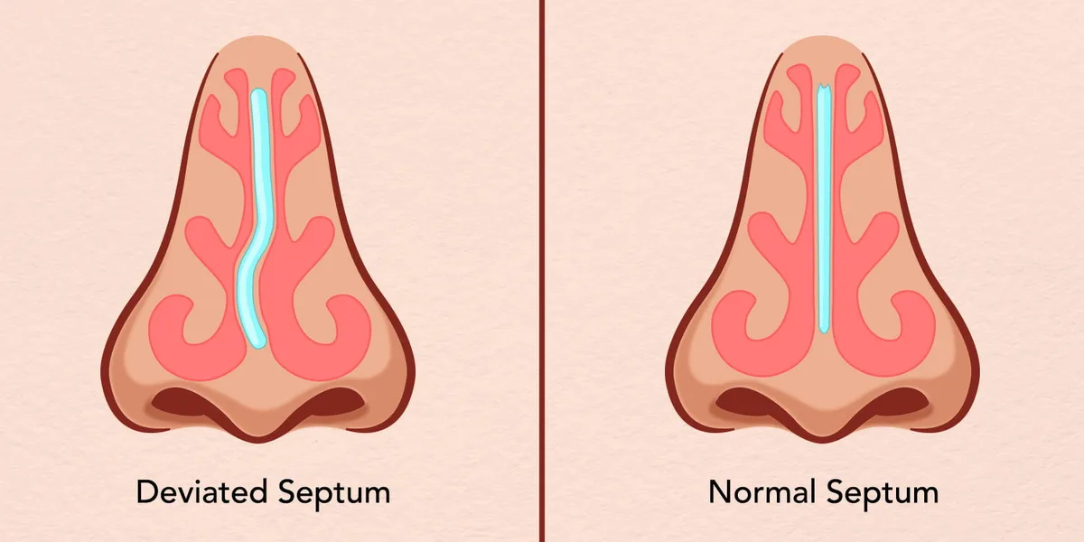 How To Fix A Deviated Septum Without Surgery