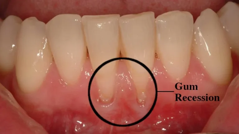How To Fix Receding Gums