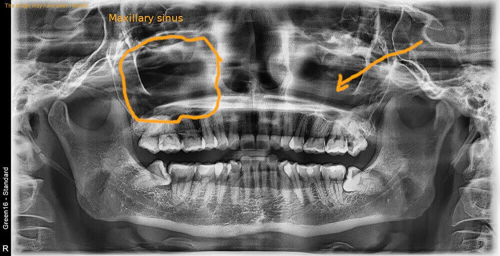 Pain Where Wisdom Tooth Was Removed Years Later